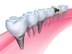 Dental Implants Ajax ON Image